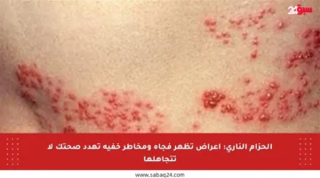 الحزام الناري: أعراض تظهر فجأة ومخاطر خفية تهدد صحتك لا تتجاهلها